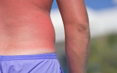 Vitamina D para protegerte del sol