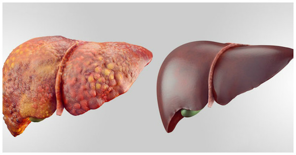 cirrosis