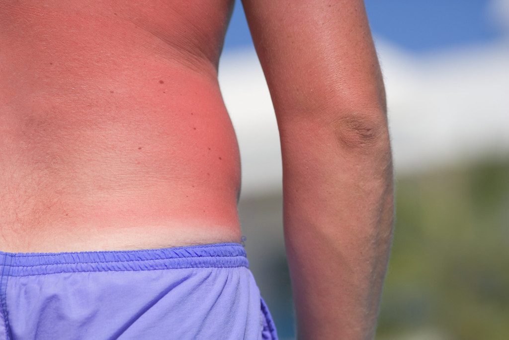 vitamina D sol